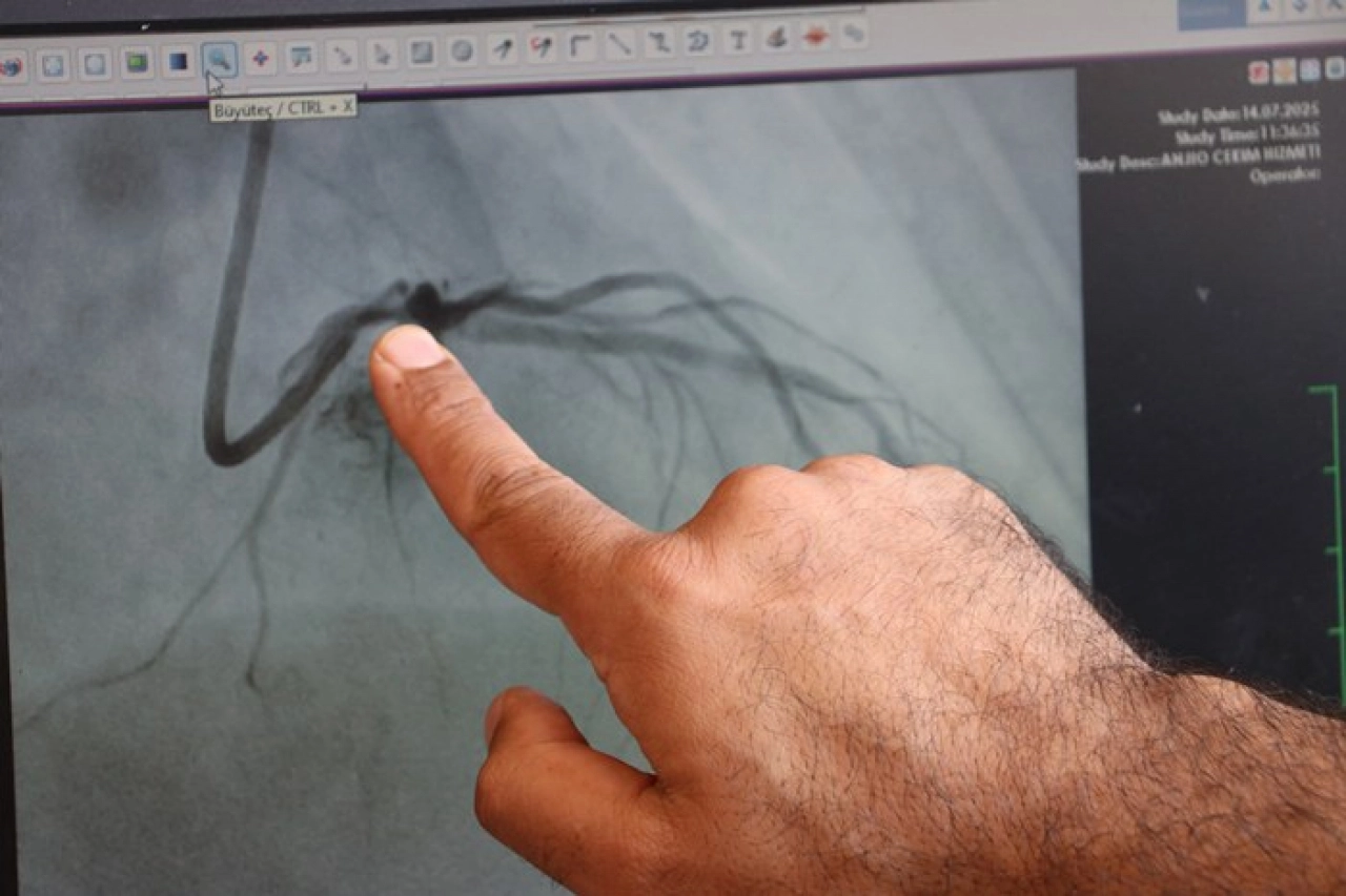 Elazığ'da Bir İlk: Kalp Damarı Tıraşlanarak Açıldı