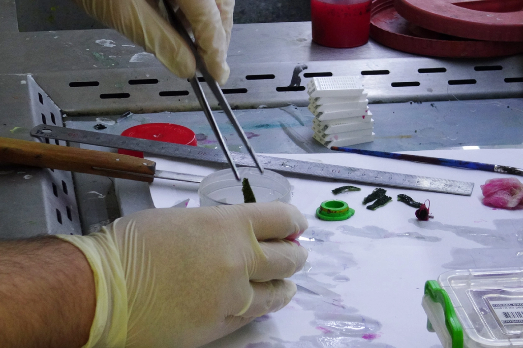 Patolojiye Gönderilen Her Örnek Kanser Değildir