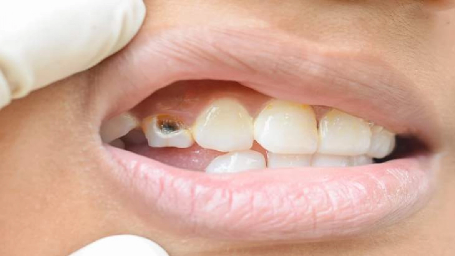 Sağlık Sorunlarınızın Nedeni Dişleriniz Olabilir