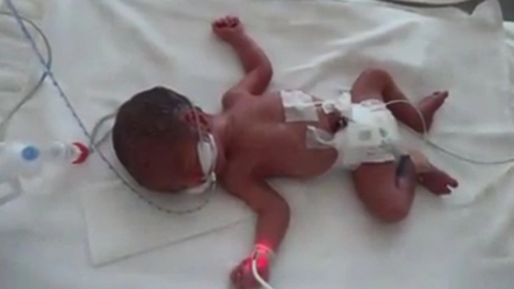 Kayseri Şehir Hastanesi'nin ilk dördüz bebekleri dünyaya geldi