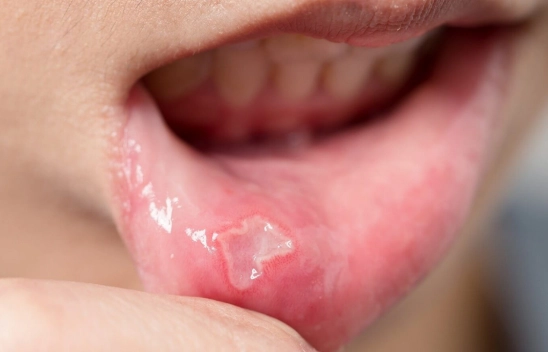 Ağız içinde geçmeyen yaralar kanser belirtisi olabilir!