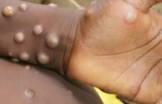 Maymun çiçeği: Afrika'da 18 binden fazla doğrulanmış veya olası vaka