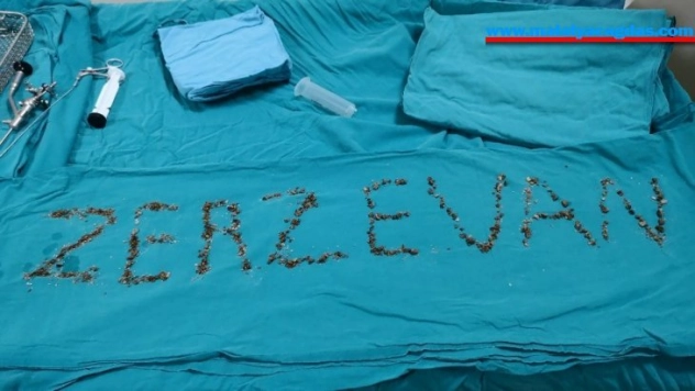 Böbreğinden 'Zerzevan' çıktı