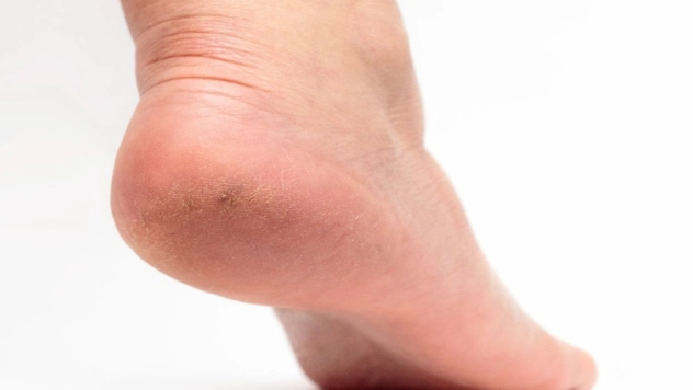 Diyabetlilerde topuk çatlağı kangrene kadar gidebiliyor!