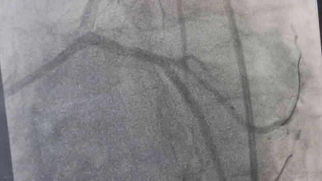 Dünyada yılda 500 bin insanın ölümü trans yağlardan