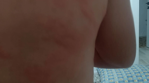 Böcek ısırığı hastanelik etti