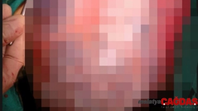 Genç kadının karnındaki 30 santimetrelik kist operasyonla alındı