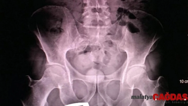 İranlı kadının şok eden uyuşturucu taşıma yöntemini polis fark etti