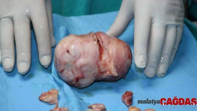 Karnından 15 santimlik miyom çıktı