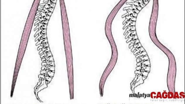 Omurga yetmezliğine dikkat