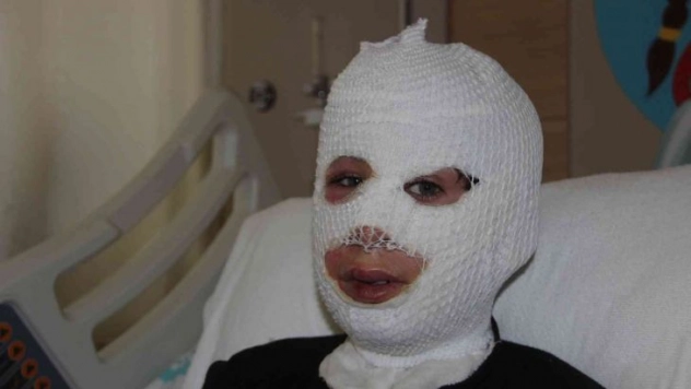 Sobada ayaklarını ısıtırken kendini yaktı