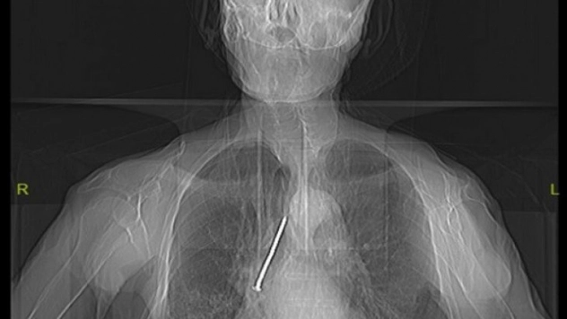 Soluk borusuna kaçan 10 santimlik çivi çıkarıldı