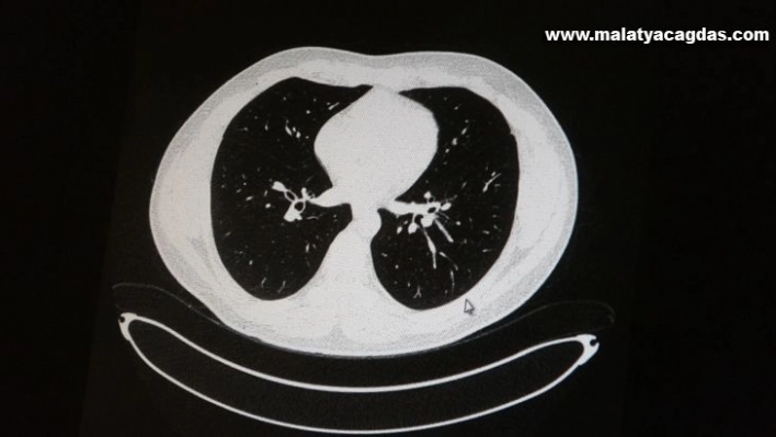 Aşılı ve aşısız olarak koronaya yakalanan 2 gencin akciğer tomografisi korkunç gerçeği gözler önüne serdi