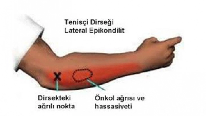 Tenisçi dirseği hastalığı nedir? Nasıl tedavi edilir?