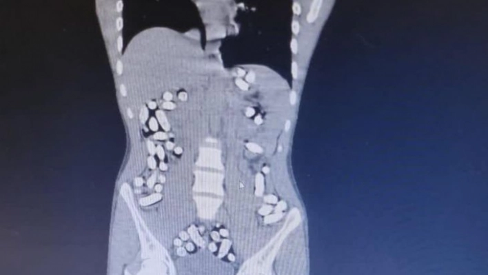 İran'dan gelen 5 kişinin midesinde 6 kilo 145 gram afyon sakızı ele geçirildi