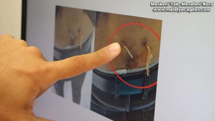 Ağrıları geçsin diye belinden çamaşır ipi geçirmişler