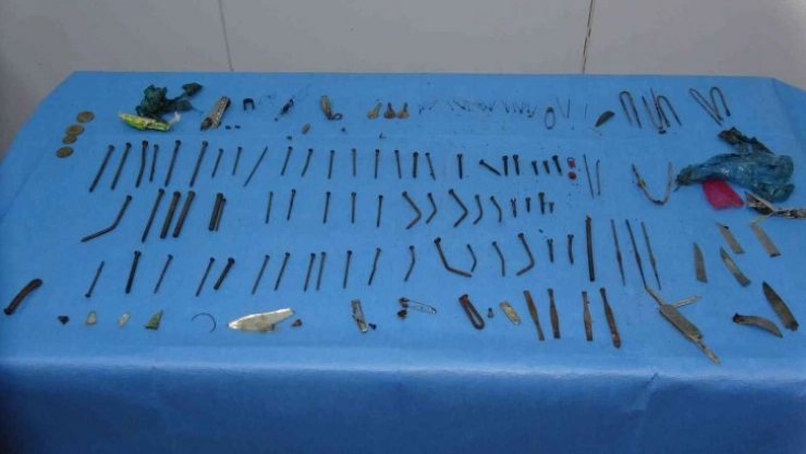 Doktorları şaşkına çeviren ameliyat: Midesinden 158 parça metal çıktı