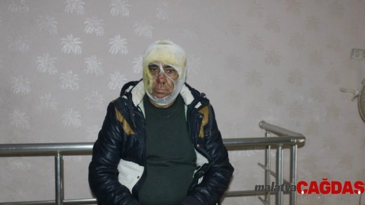 Evinde çıkan yangını söndürmek isterken yaralandı