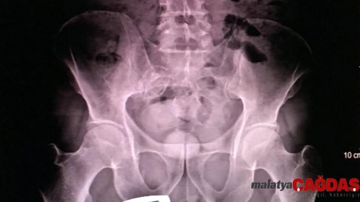 İranlı kadının şok eden uyuşturucu taşıma yöntemini polis fark etti