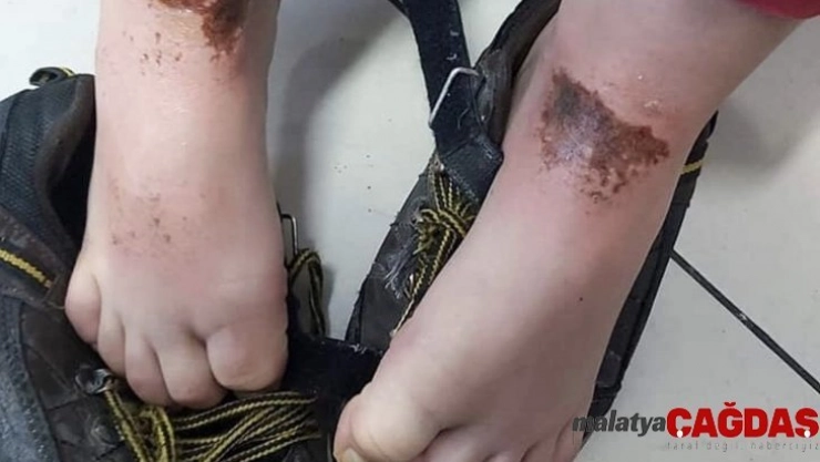 Okul bahçesinde oynayan öğrencilerin vücutlarında oluşan çürük ve yanıklar sağlık kuruluşları ile Belediyeyi harekete geçirdi