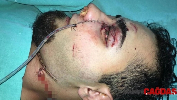 Yüzüne saplanan demir çubukla hastaneye getirilen Emre, taburcu olmaya hazırlanıyor